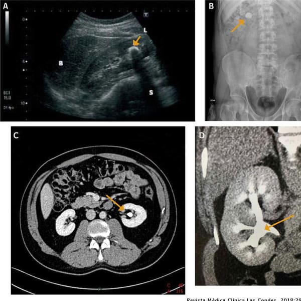 diagnostico y tratamiento del dolor renal